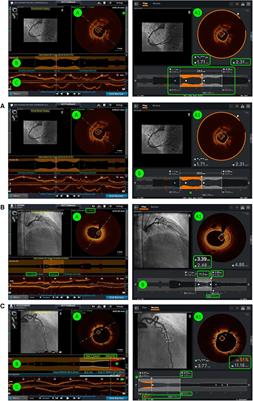 Does artificial intelligence enhance physician interpretation of optical coherence tomography: insights from eye tracking